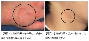 トンズラス菌